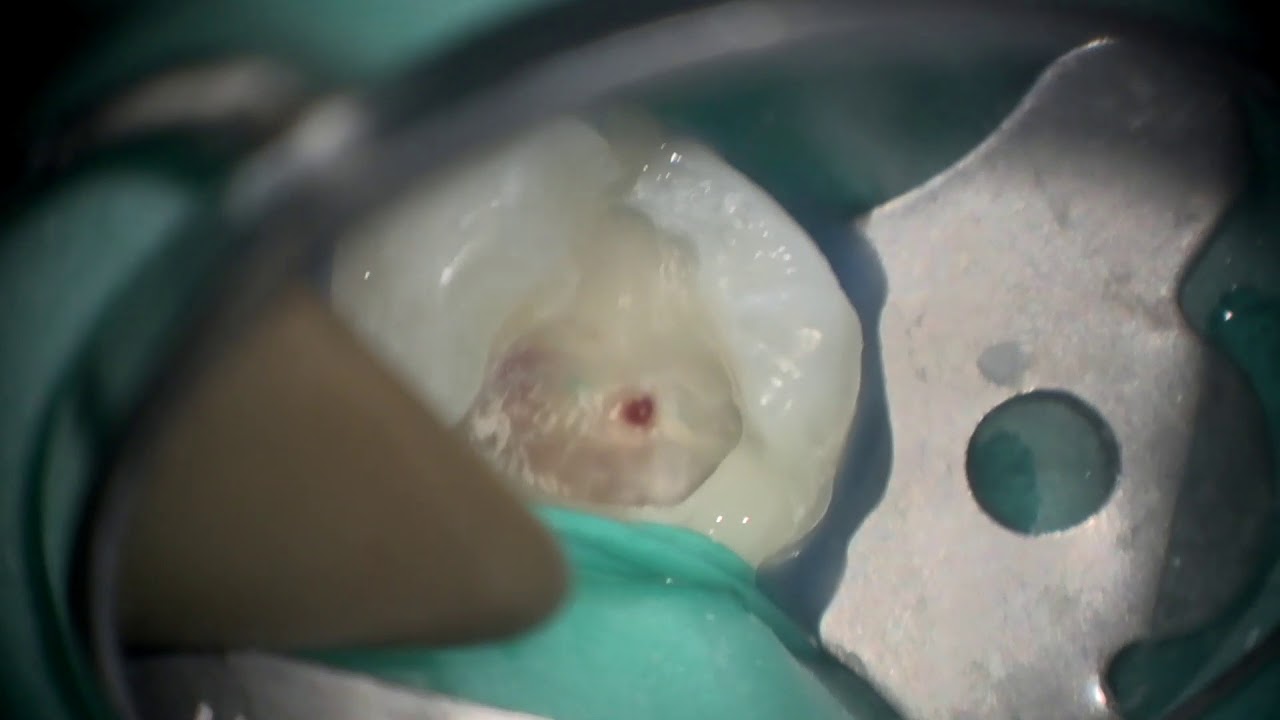 マイクロスコープ下で行った生活歯髄切断法（MTAセメント）2 | マイクロスコープ歯科 歯の神経抜かない歯医者 東京 池袋 友和デンタルクリニック