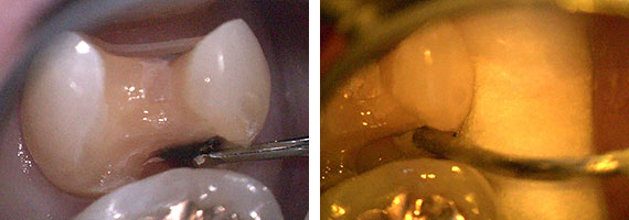セラミックインレーSTEP2 虫歯の除去