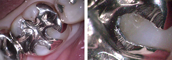 不適合銀歯STEP1 術前の状態