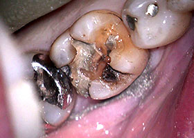 不適合銀歯STEP2 不適合なインレーの除去