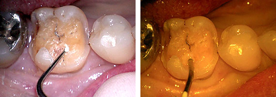 不適合銀歯STEP3 虫歯の除去