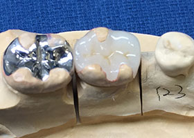 不適合銀歯STEP4 精密形成・セラミックインレーの制作