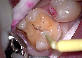 不適合銀歯STEP6 歯面にプライマーを塗布