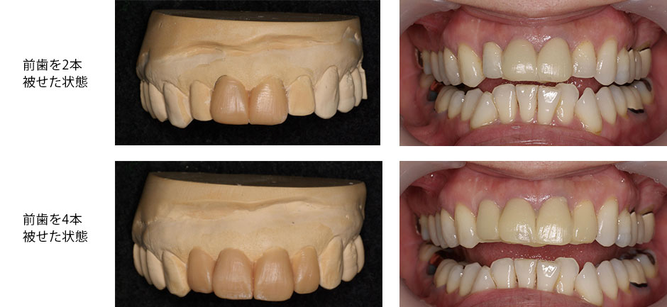 友和デンタルクリニックでは、歯を削る前に歯型の模型上シミュレーションを行い事前に治療後のイメージを確認していただきます。