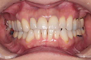 審美歯科症例 前歯2本のセラミック修復を選択されました