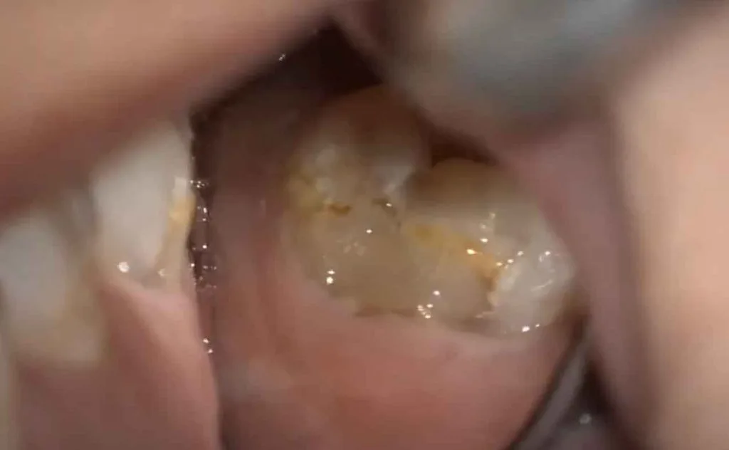 歯を守るう蝕治療 = Clinical caries management :… 初期う蝕マネジメントガイド（冊子） | 日本ヘルスケア歯科学会 | 人々