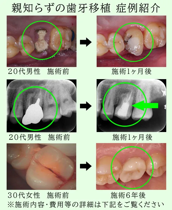 自家歯牙移植 親知らずをインプラントの代わりに自家歯牙移植できる条件とメリット