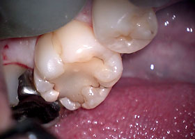 虫歯治療STEP1 術前の状態