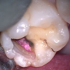 虫歯治療STEP3 状態確認