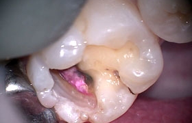 虫歯治療STEP3 状態確認