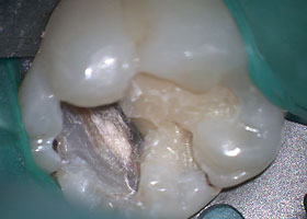 虫歯治療STEP4 虫歯除去