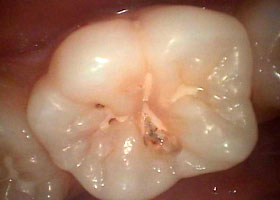 MTAセメントSTEP2 虫歯の除去