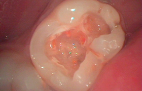 二回法STEP2 虫歯の除去