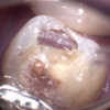 セラミック修復STEP2 虫歯の進行