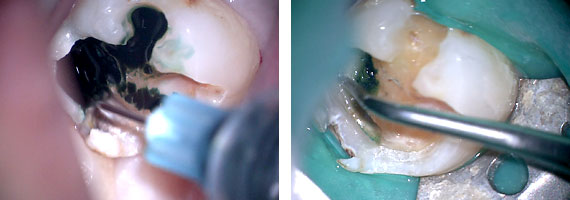 MTAセメントSTEP3 深い虫歯の除去