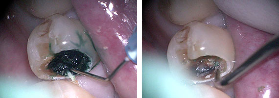 二次虫歯STEP3 深い虫歯の除去