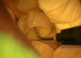 二次虫歯STEP4 神経の封鎖