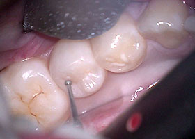 マイクロスコープ虫歯治療STEP1 術前