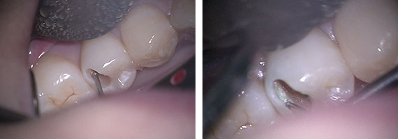 マイクロスコープ虫歯治療STEP2 最小限に削る