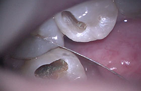 マイクロスコープ虫歯治療STEP3 状態確認
