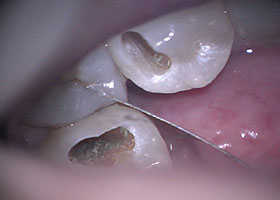 マイクロスコープ虫歯治療STEP3 状態確認