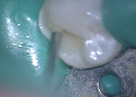 マイクロスコープ虫歯治療STEP5 神経の封鎖