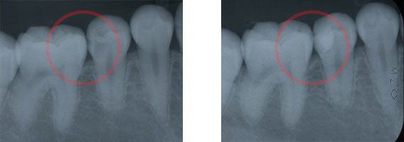 マイクロスコープ虫歯治療STEP6 レントゲン