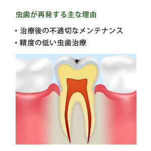 虫歯が発生する主な理由のイラスト