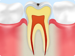 虫歯の進行段階 C0 ごく初期段階の虫歯