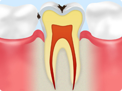 虫歯の進行段階 C1 歯の表面が侵される初期の虫歯