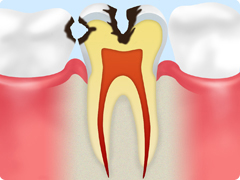 虫歯の進行段階 C2 神経の近くにまで達している虫歯