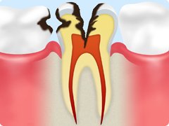 虫歯の進行段階 C3 神経にまで進んでしまった虫歯