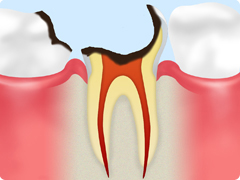 虫歯の進行段階 C4 歯の大部分を失った末期の虫歯