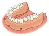 入れ歯（保険適用の場合）のイメージ
