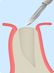 インプラント治療STEP1 歯ぐきの切開