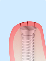 インプラント治療STEP4 歯ぐきの縫合