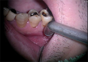 無痛治療STEP1 治療する歯の特定