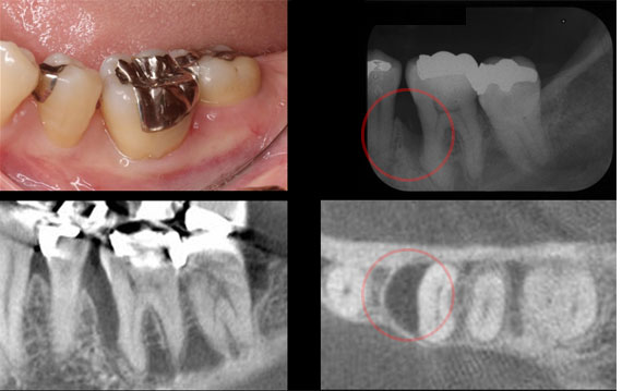 歯周病治療STEP1 歯周病初期治療終了後
