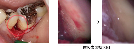 歯周病治療STEP2 歯周組織再生療法