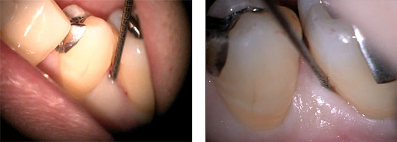 歯周病治療STEP3 歯周組織再生療後