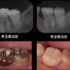 歯周病治療症例紹介1 歯周組織再生療法：他院で改善されなかった歯周ポケットを歯周組