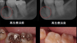 歯周病治療STEP4 術前からの経過
