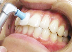 歯科医院での虫歯予防を徹底しましょう