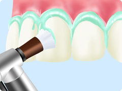 PMTC（Professional Mechanical Tooth Cleaning）