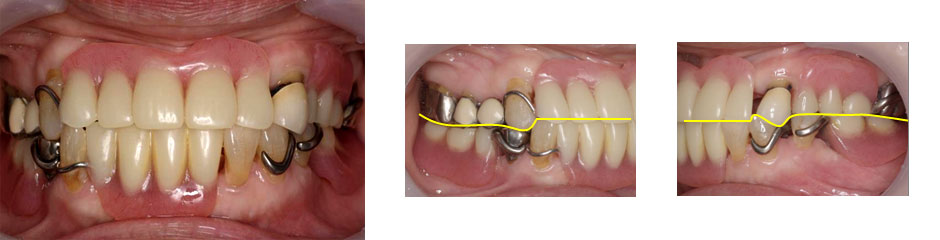 入れ歯の症例紹介 初診時の写真