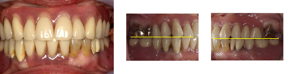 入れ歯の症例紹介 術後の写真1
