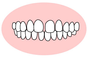 すきっ歯／空隙歯列（くうげきしれつ）のイメージ