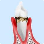 歯周病中等度のイメージ