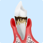歯周病重度のイメージ