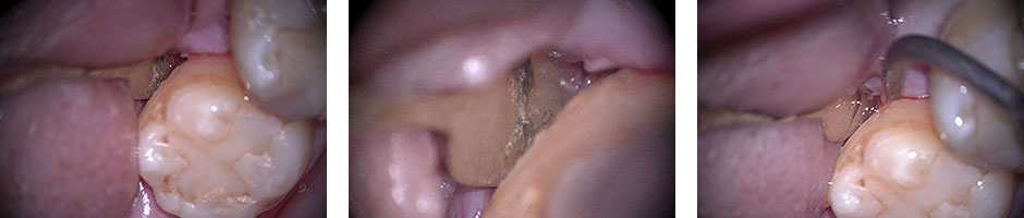 深い歯周ポケットにおける歯石の除去を歯科用顕微鏡下でおこなっている様子